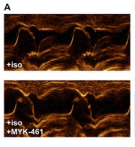 image with two panels comparing obstructed and clear pathways for blood flow