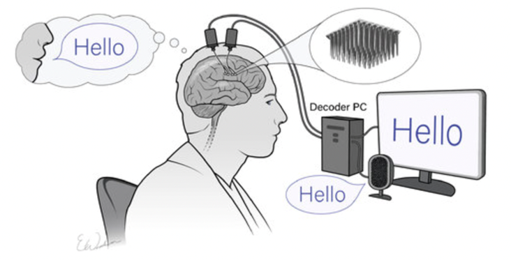 Diagram shows electrodes in a person's brain connected to a computer. 