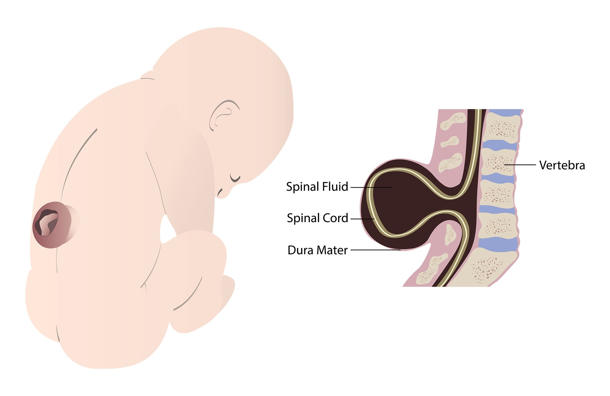 Infographic showing spina bifida